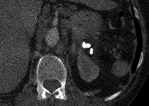 surgical clip metal artifact reduction (MDT)