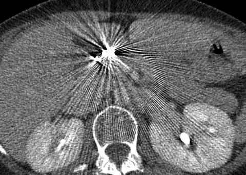 embolization coil metal artifact (FBP)