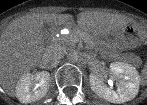 embolization coil metal artifact reduction (MDT)