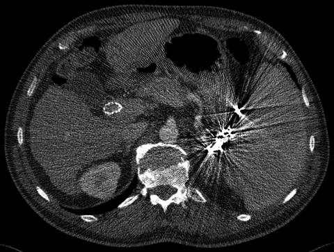 embolization coil metal artifact (FBP)