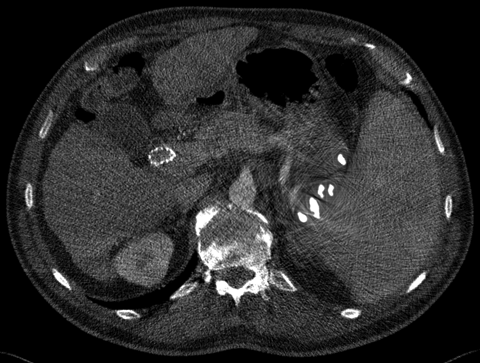 embolization coil metal artifact reduction (MDT)