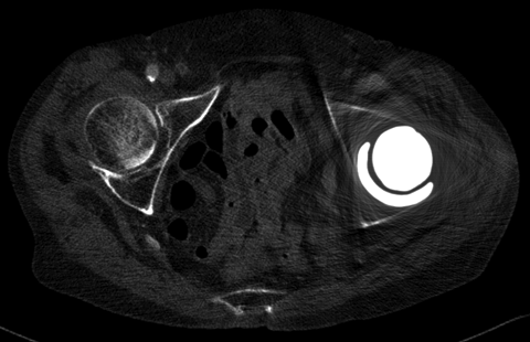 hip replacement metal artifact reduction (MDT)