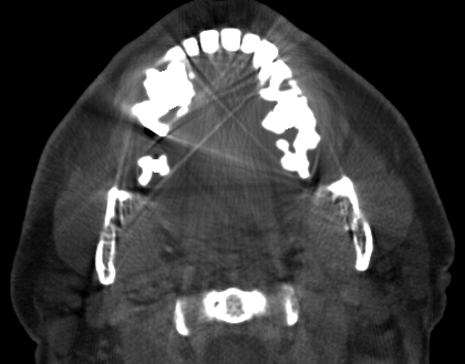 dental fillings metal artifact reduction (MDT)