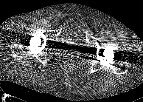 bilateral hip replacement metal artifact (FBP)