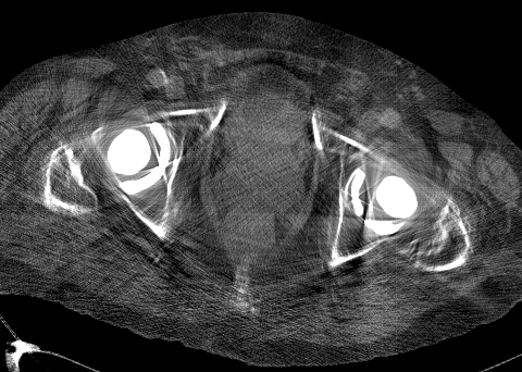 bilateral hip replacement metal artifact reduction (MDT)