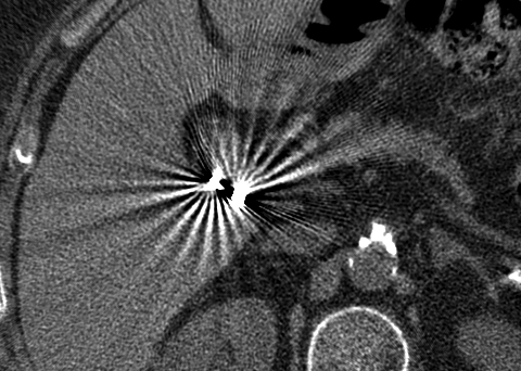 cholecystectomy clip metal artifact (FBP)