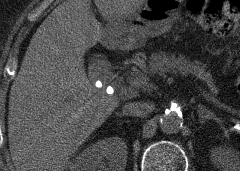  metal artifact reduction (MDT)