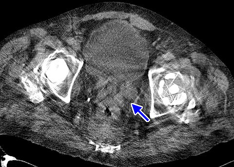 bilateral hip replacement metal artifact reduction (MDT)