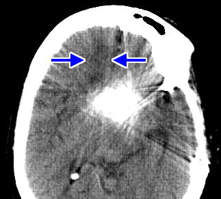 aneurysm clip metal artifact reduction (MDT)