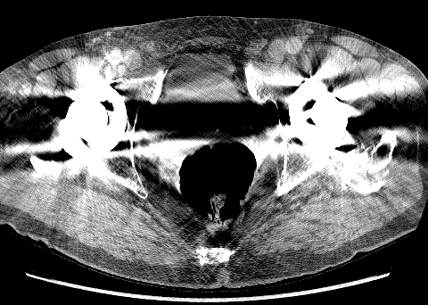 bilateral hip replacement metal artifact (FBP)