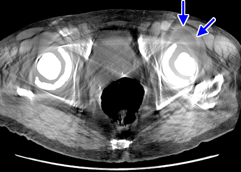 bilateral hip replacement metal artifact reduction (MDT)