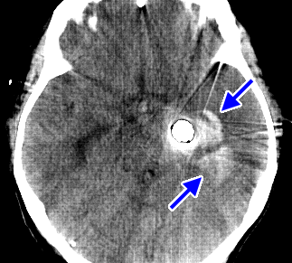 aneurysm clip metal artifact reduction (MDT)